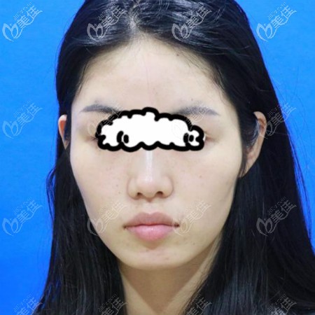 在武漢亞韓整形找趙貴慶做顴骨顴弓內(nèi)推和長曲線下頜角截骨術前照片 在武漢亞韓整形找趙貴慶做顴骨顴弓內(nèi)推和長曲線下頜角截骨術前照片