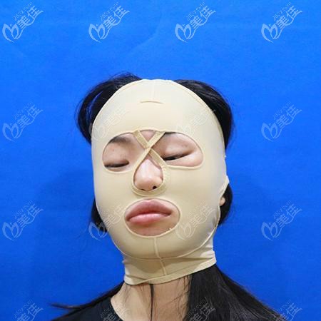 亞韓趙貴慶給我做顴骨和下頜角手術第4天效果圖片 亞韓趙貴慶給我做顴骨和下頜角手術第4天效果圖片