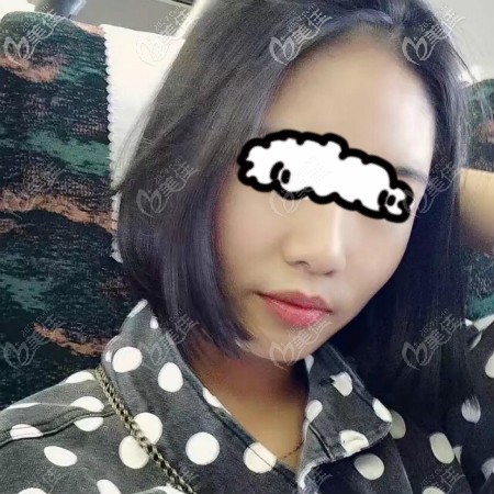 我找武漢亞韓趙貴慶做顴骨+下頜角手術恢復2個月效果 我找武漢亞韓趙貴慶做顴骨+下頜角手術恢復2個月效果