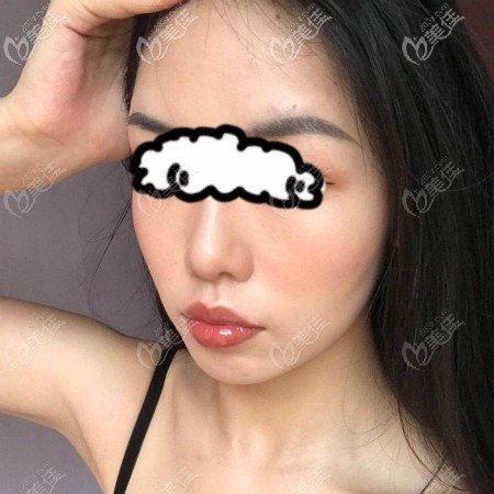 在武漢亞韓找趙貴慶做顴骨顴弓降低和下頜角磨骨手術恢復6個月效果 在武漢亞韓找趙貴慶做顴骨顴弓降低和下頜角磨骨手術恢復6個月效果