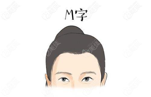 m型發(fā)際線示例圖片