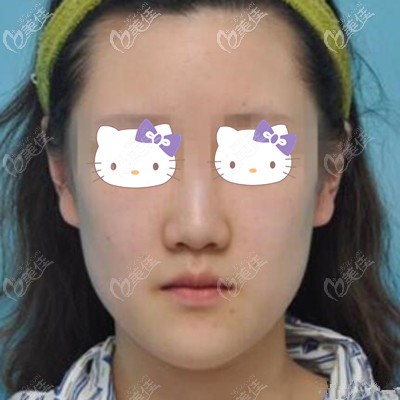 隆鼻術(shù)前照 隆鼻術(shù)前照