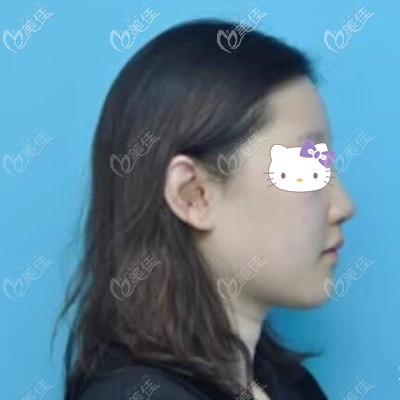 鼻整形術(shù)后第8天 鼻整形術(shù)后第8天