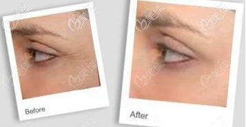 進(jìn)口玻尿酸去除魚(yú)尾紋案例 進(jìn)口玻尿酸去除魚(yú)尾紋案例