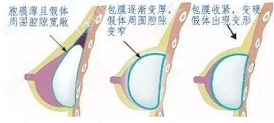 隆胸假體出現(xiàn)包膜攣縮 隆胸假體出現(xiàn)包膜攣縮
