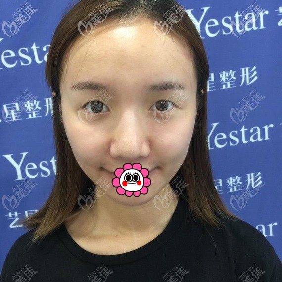 到寧波藝星做雙眼皮前 到寧波藝星做雙眼皮前