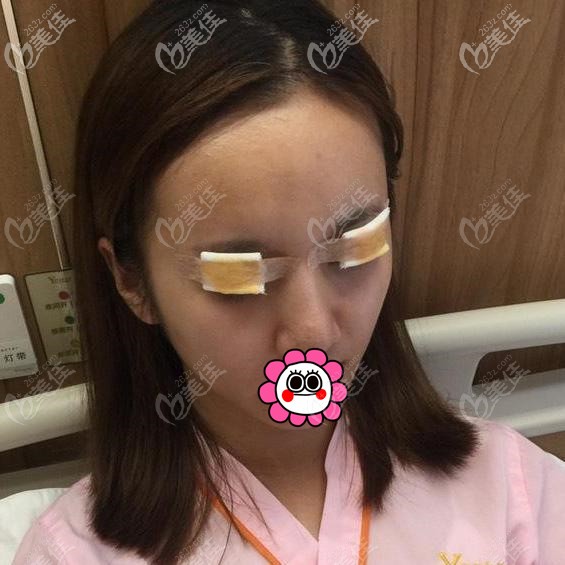 寧波藝星雙眼皮術(shù)后即刻 寧波藝星雙眼皮術(shù)后即刻