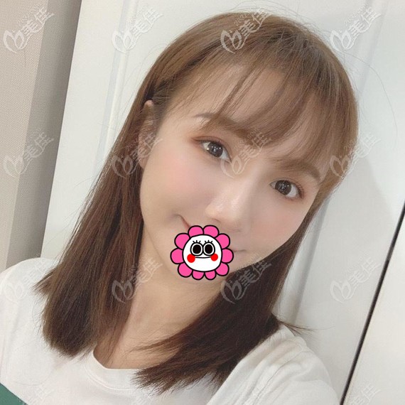 寧波藝星王昊雙眼皮恢復(fù)一個(gè)月<span style= 寧波藝星王昊雙眼皮恢復(fù)一個(gè)月<span style=