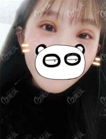 做眼綜合后的前半個月處于腫脹期