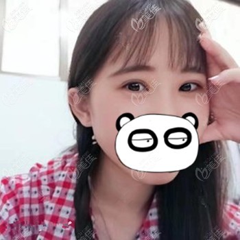 做了眼綜合后朋友感慨：術(shù)后雙眼皮有了上瞼下垂也改善了簡(jiǎn)直一舉兩得呀！