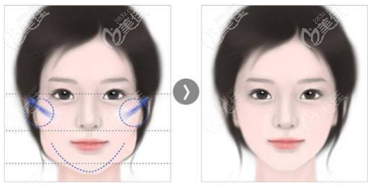 面部輪廓整形手術(shù)效果 面部輪廓整形手術(shù)效果