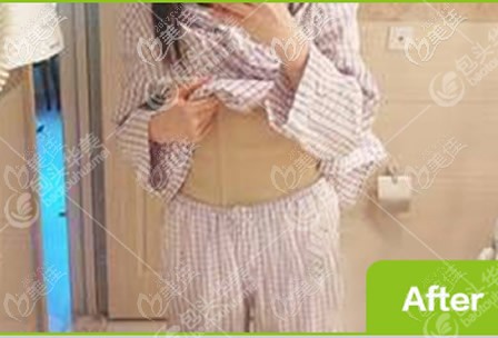 我在包頭華美腰腹部吸脂后穿著塑身衣