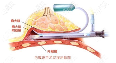 內窺鏡隆胸手術過程示意圖 內窺鏡隆胸手術過程示意圖