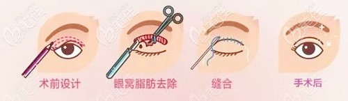 腫眼泡做全切雙眼皮手術(shù)過程 腫眼泡做全切雙眼皮手術(shù)過程