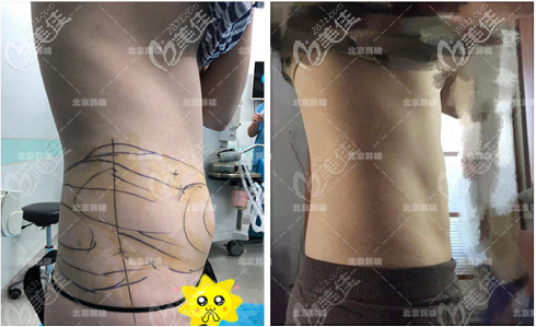 <!--<i data=20240703-sp></i>-->芒果威塑真人術前術后對比圖