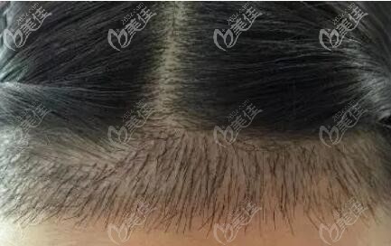 前額發(fā)際線植發(fā)效果 前額發(fā)際線植發(fā)效果