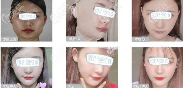 我是做了顴骨磨骨下頜角磨骨才讓原來變瓜子臉的 我是做了顴骨磨骨下頜角磨骨才讓原來變瓜子臉的