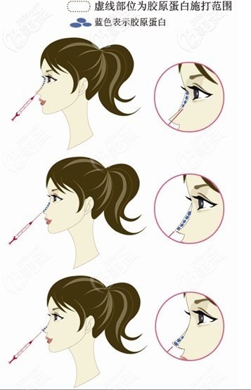 膠原蛋白注射隆鼻