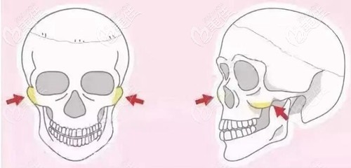 顴骨部位需要改善的情況 顴骨部位需要改善的情況