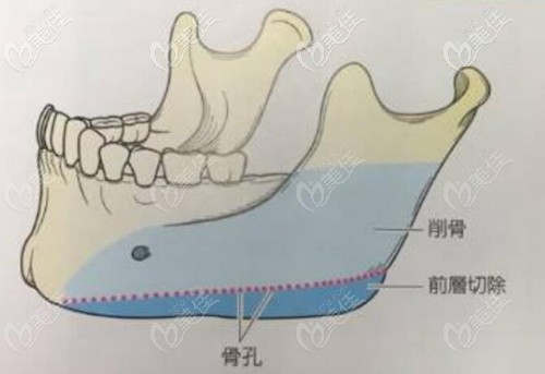下頜骨削骨和長曲線截骨 下頜骨削骨和長曲線截骨
