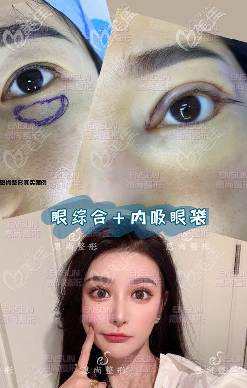 內(nèi)吸去眼袋+切開雙眼皮+開內(nèi)眼角的眼部小綜合整形