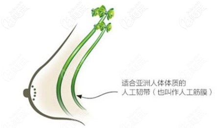 人工韌帶胸部提升 人工韌帶胸部提升