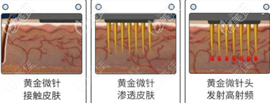 黃金微針去痘坑過(guò)程示意圖 黃金微針去痘坑過(guò)程示意圖