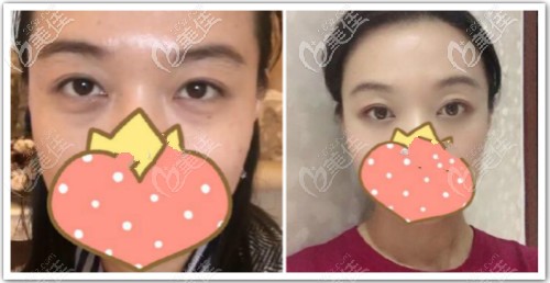 眶隔釋放祛眼袋+淚溝填充效果圖片