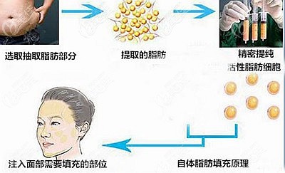 自體脂肪填充面部的原理 自體脂肪填充面部的原理