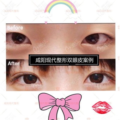 咸陽現(xiàn)代整形雙眼皮案例 咸陽現(xiàn)代整形雙眼皮案例