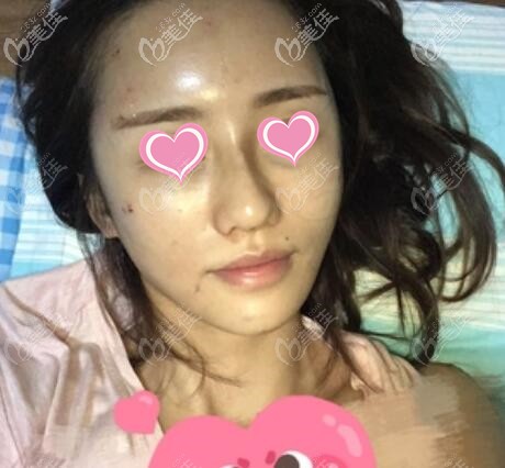 面部脂肪填充術后第2天