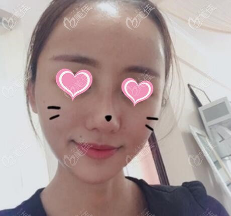 做完面部脂肪填充術后16天照