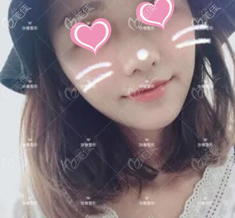 做面部脂肪填充術后1個月的恢復效果照