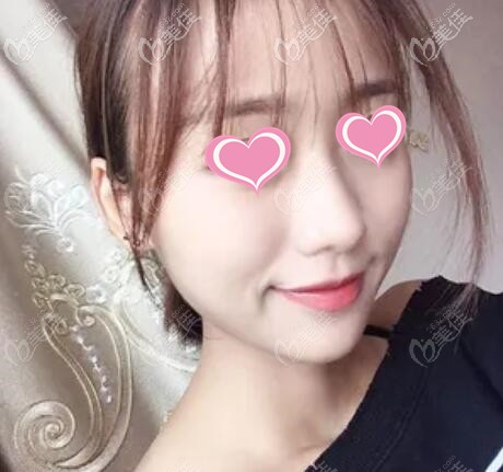 面部脂肪填充案例：做了全臉自體脂肪填充之后讓我終于重拾少女臉~