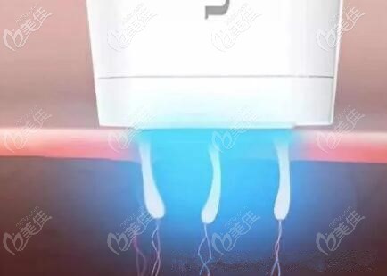 光子治療痤瘡的過程示意圖 光子治療痤瘡的過程示意圖