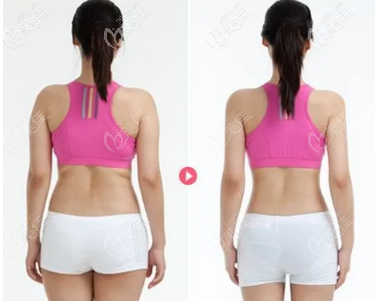 后背抽脂前后對(duì)比照片 后背抽脂前后對(duì)比照片