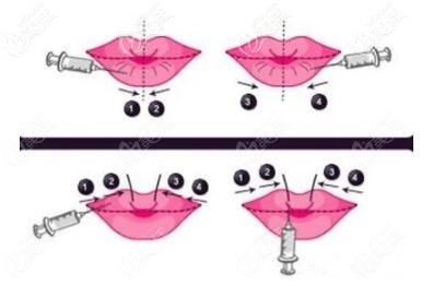 注射膠原蛋白豐唇 注射膠原蛋白豐唇