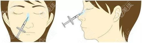 注射隆鼻的部位