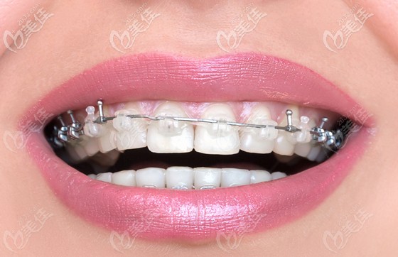 曾益平擅長青少年及成人錯合畸形矯正 曾益平擅長青少年及成人錯合畸形矯正