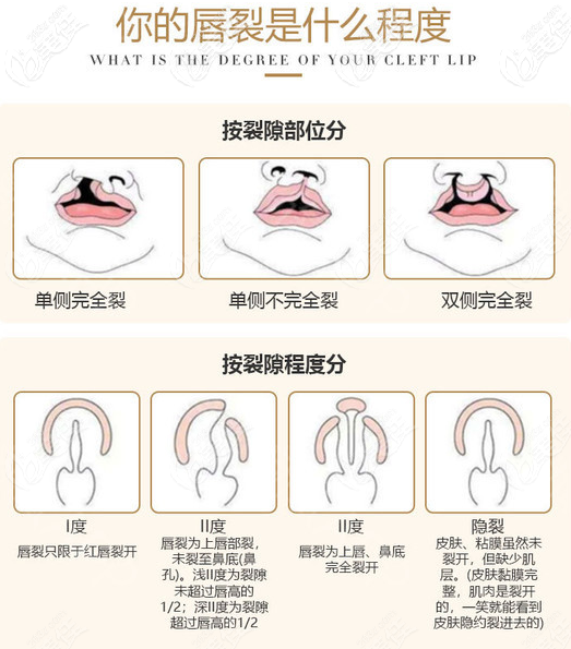 不同程度的唇腭裂參考示意圖 不同程度的唇腭裂參考示意圖