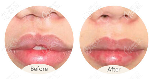 唇腭裂完全修復(fù)后圖片 唇腭裂完全修復(fù)后圖片