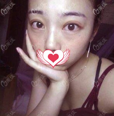 這是手術(shù)一周的照片 這是手術(shù)一周的照片