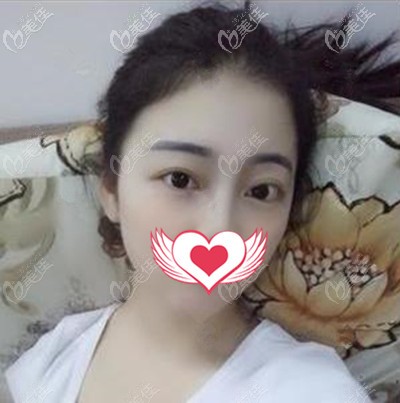 想知道在泉州美萊華美做雙眼皮+開眼角的我眼睛恢復(fù)過程嗎?快戳這...