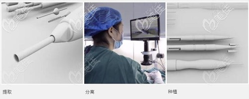 新生3D植發(fā)技術原理 新生3D植發(fā)技術原理