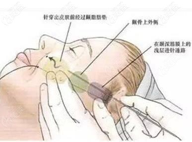 埋線提升手術(shù)