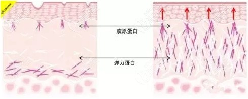 埋線失敗修復(fù)術(shù)后恢復(fù)平整