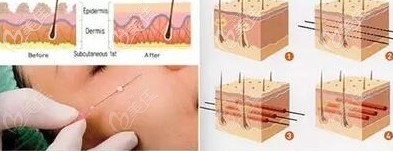 埋線失敗修復(fù)手術(shù)