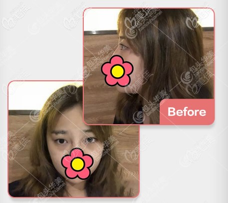 包頭華美整形醫(yī)院做眼綜合手術(shù)前 包頭華美整形醫(yī)院做眼綜合手術(shù)前