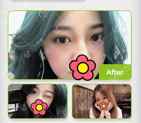 我30歲,1個(gè)月前剛找張誠做了埋線雙眼皮,沒選擇全切雙眼皮是害怕術(shù)后有肉條和疤痕!