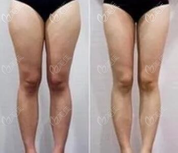 吸脂瘦大腿前后對比照 吸脂瘦大腿前后對比照